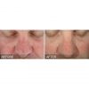 HydraFacial B&A