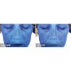 HydraFacial® Before and After