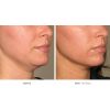 Ultherapy - Face Area (12 options)