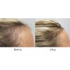 Professional Hair Growth Program