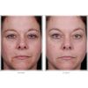 Obagi Blue Peel before and after