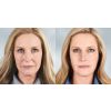 Sculptra Aesthetic B&A 2