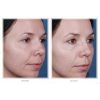 Obagi Blue Peel before and after