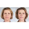 Sculptra Aesthetic