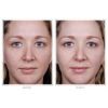 Obagi Blue Peel before and after