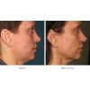Ultherapy - Face Area (12 options)