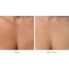 Ultherapy - Face Area (12 options)