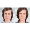 Sculptra Aesthetic B&A 3