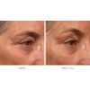 Ultherapy - Face Area (12 options)