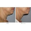 Ultherapy - Face Area (12 options)