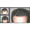 NeoGraft Before & After 1