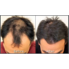 NeoGraft Before & After 2