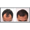 NeoGraft Before & After 4