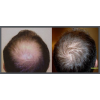 NeoGraft Before & After 5