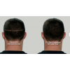 Strip Transplant vs FUE Transplant