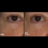 Skinbetter Science® InterFuse™ Treatment Cream EYE Before & After