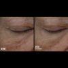 Skinbetter Science® InterFuse™ Treatment Cream EYE Before & After