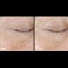 Skinbetter Science® InterFuse™ Treatment Cream EYE Before & After