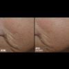 Skinbetter Science® Interfuse® Treatment Face & Neck Cream Before & After