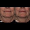 Skinbetter Science SBS Interfuse Treatment Cream FACE & NECK