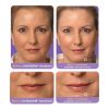 JUVÉDERM® Ultra Plus XC 