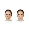 JUVÉDERM® Ultra Plus XC (2 options) (CA)