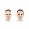 JUVÉDERM® Ultra Plus XC (2 options) (CA)