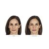JUVÉDERM® Ultra XC (4 opts)