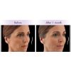 Juvederm Voluma XC Kathy