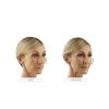 Juvederm Voluma XC B&A