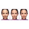 JUVÉDERM® Ultra XC (4 opts)