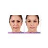 JUVÉDERM® Ultra XC (4 opts)