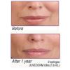 JUVÉDERM® Ultra XC 