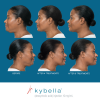 Kybella Before1 and After