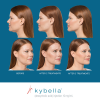 Kybella Before and After 5