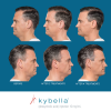 Kybe6lla Before and After 6
