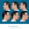 Kybella Before and After 7
