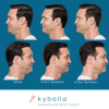 Kybella Before and After 8