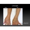 Limelight IPL before and after