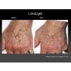 Limelight IPL before and after