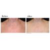 Limelight IPL before and afterLimelight IPL before and after