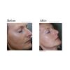 Limelight IPL before and after