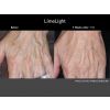 Limelight IPL before and after