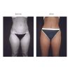 Tumescent Liposcution Before & After 4