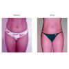Tumescent Liposcution Before & After 6