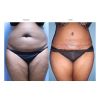 Tumescent Liposcution Before & After 7