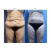 Tumescent Liposcution Before & After 8