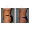 Tumescent Liposcution Before & After 5