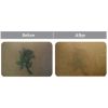 Laser Tattoo Removal B&A 1