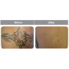 Laser Tattoo Removal B&A5